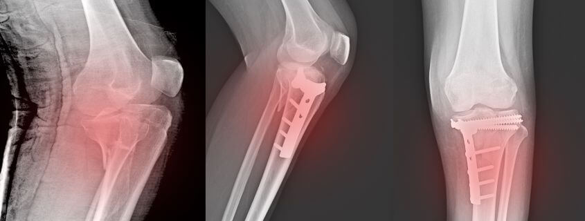 radiografia da fratura por estresse no joelho