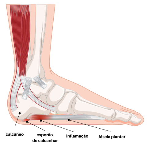 Anatomia da fascite plantar