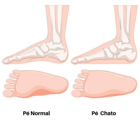 diferença pé normal e pé chato